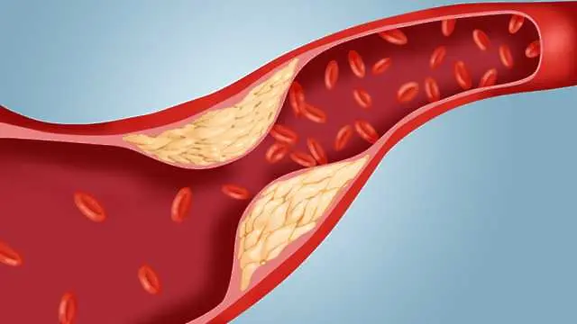 Учени: Полезният холестерол понякога увеличава риска от инфаркт
